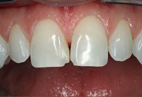 Palmetto Pain Management | Sports Mouthguards, Juvederm reg  and Ceramic Crowns